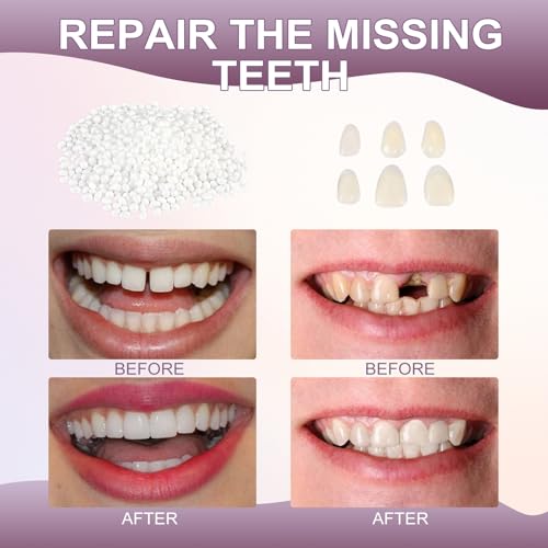 Tooth Repair kit，Teeth Repair Kit for Filling The Missing Broken Tooth and Gaps-Moldable Fake Teeth and Thermal Beads Temporary Replacement Kit-L002