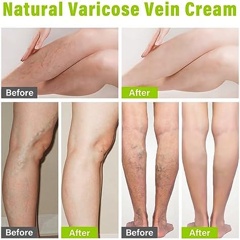 MOSKILA Varicose Veins Treatment for Legs, 2 Count Nature Varicose Veins Cream, Effective Varicose Veins Treatment for Varicose & Spider Veins, Relieve Leg Swelling & Fatigue Relief, 0.7oz