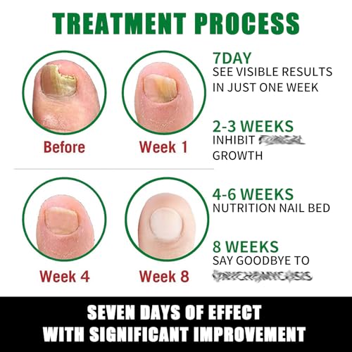 Ginger Nail Treatment Nail Support Nail Care, 7days Nail Treatment, Ginger Nail Growth Serum, Ginger Cuticle Care Oil for Nails,Cuticle Serum for Nails (3Pcs, 1 Fl.oz(pack of 1))